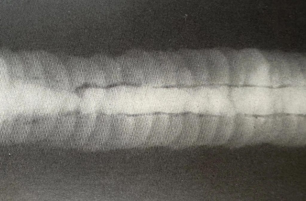 Comparison Atlas of Welding Defects and Non-Destructive Testing Images 32 条状夹渣